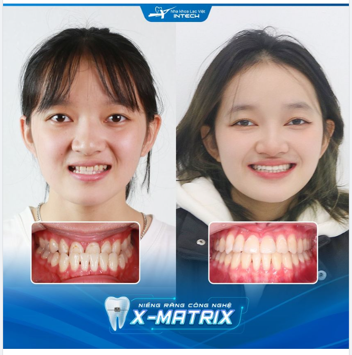 THÁO NIỀNG TRƯỚC TẾT:TỰ TIN CƯỜI XINH - ĐÓN CHÀO NĂM MỚI