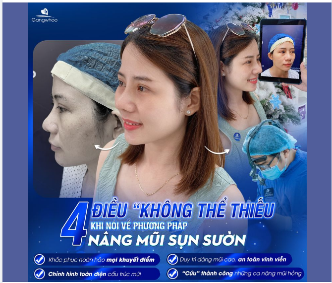 NÂNG MŨI SỤN SƯỜN – PHƯƠNG PHÁP NÂNG MŨI CAO CẤP NHẤT 2023