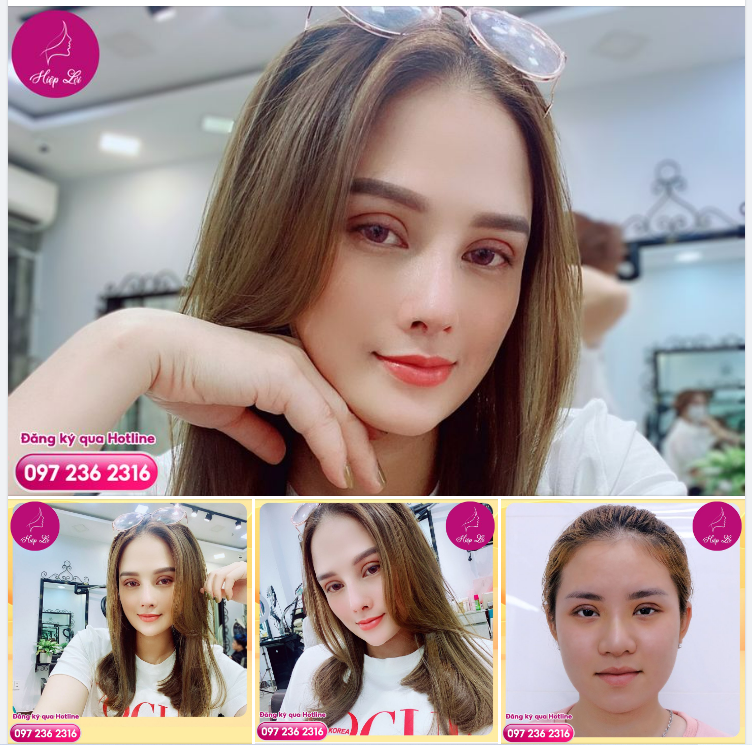 Feedback ngọt ngào đến từ khách thân quen nhà Hiệp Lợi, khi chị chọn làm đẹp Combo cho đôi mắt tươi tắn hơn: Cắt mí trên/ dưới + Nâng cung chân mày