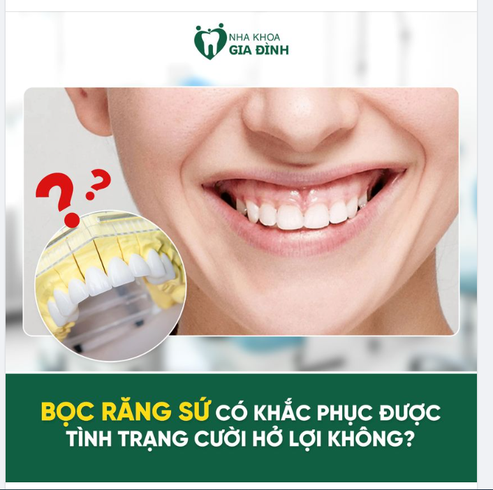 Bọc răng sứ có khắc phục được tình trạng cười hở lợi?