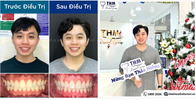 Thay Đổi Nụ Cười Cùng Nha Khoa Thế Hệ Mới