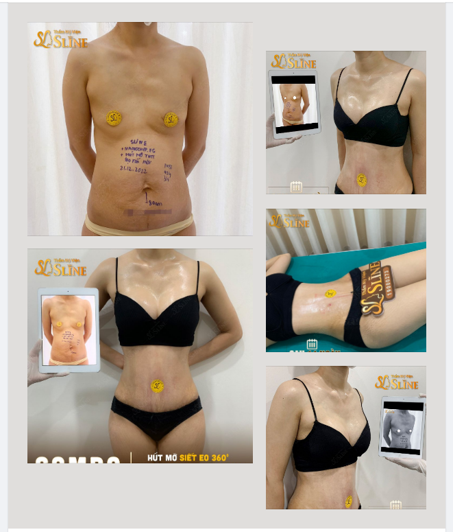 ĐIÊU KHẮC BODY cùng SLINE
