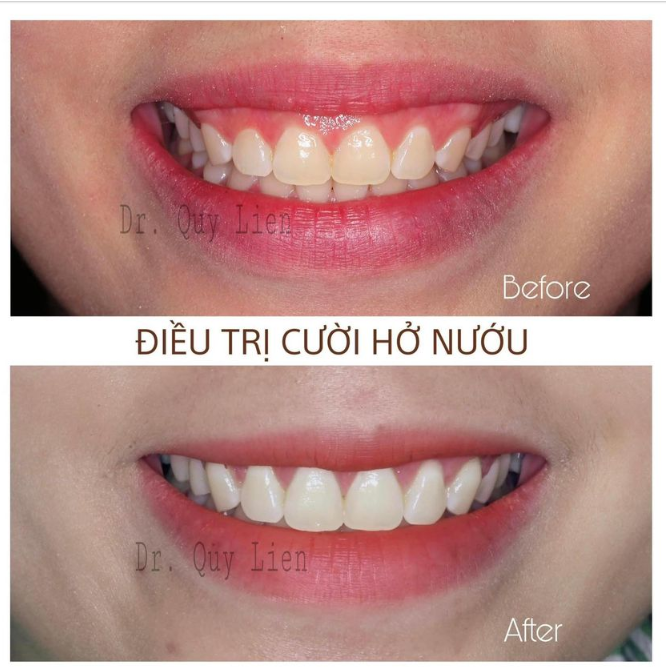 Vì sao cắt nướu thẩm mỹ nên dùng dao mổ thay vì laser