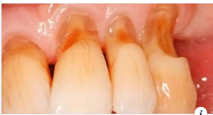Chân răng bị mục phải làm sao để khắc phục?