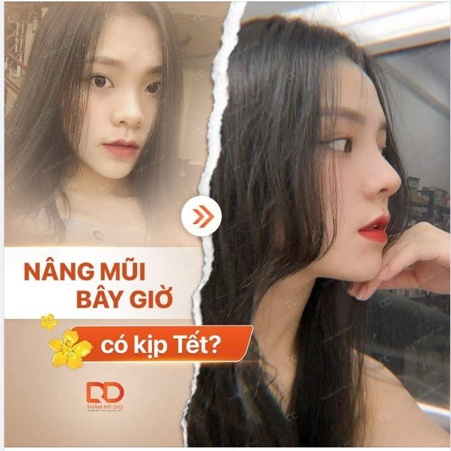 NÂNG MŨI BÂY GIỜ CÓ KỊP TẾT KHÔNG?