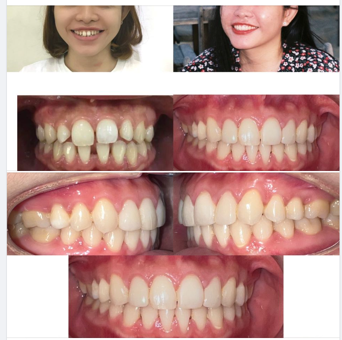 CẢI THIỆN NỤ CƯỜI SAU HAI NĂM CHỈNH NHA