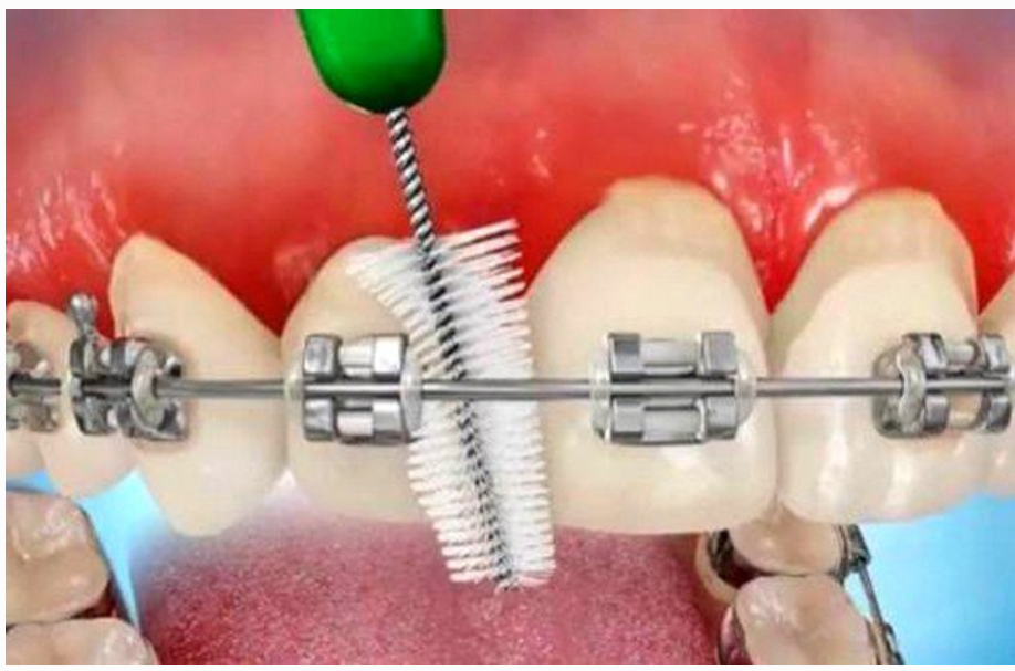 Tại sao nên dùng bàn chải kẽ răng cho răng niềng?
