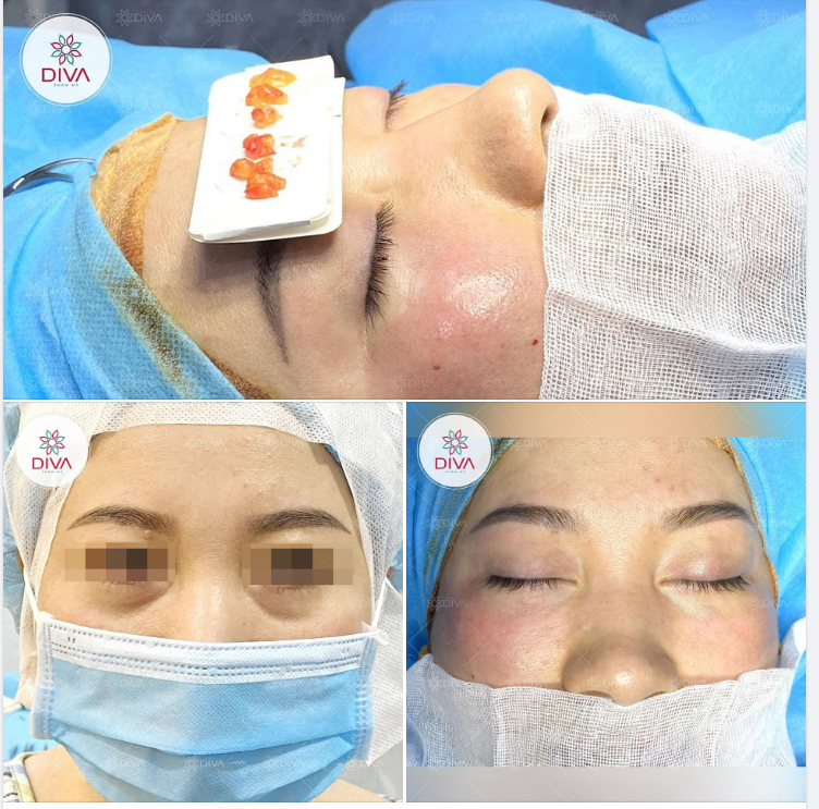 LẤY TÚI MỠ MẮT DƯỚI: TRẺ HÓA VÙNG MẮT HIỆU QUẢ