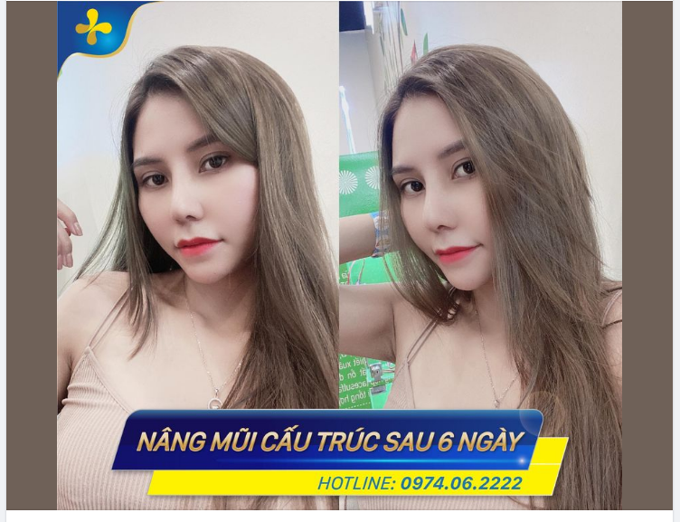 Nâng mũi cấu trúc ngày thứ 6 không còn sưng tím gì cả, mũi lên dáng tự nhiên và thon gọn dù chưa cắt chỉ.