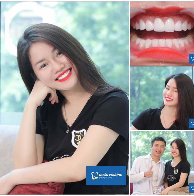 Răng sứ sau 3 năm vẫn sáng đẹp như ngày đầu tiên