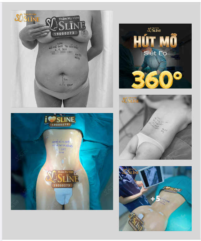 HÚT MỠ SIẾT EO 360 đã thay đổi cô ấy như thế nào