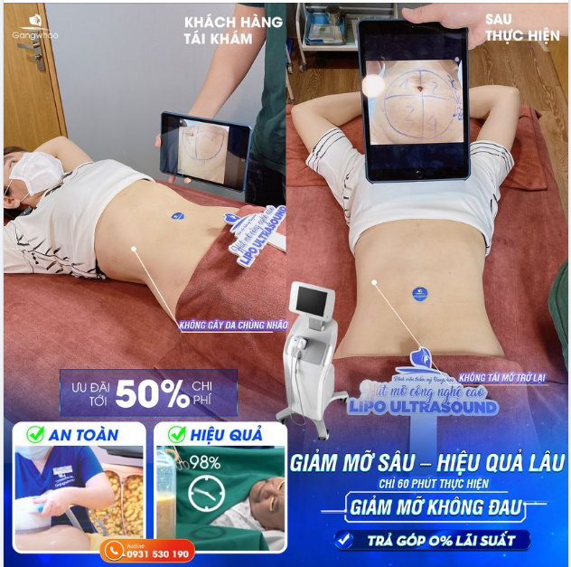 TỰ TIN VÓC DÁNG THON GỌN ĐÓN TẾT VỚI LIPO ULTRASOUND