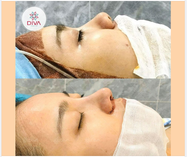 KẾT QUẢ THẨM MỸ SAU NÂNG MŨI SLINE SỤN TỰ THÂN