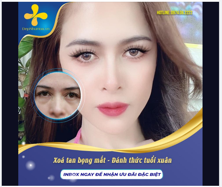 THỜI GIAN TRÔI QUA, PHẦN BỌNG MẮT XẤU XÍ TRỞ THÀNH NỖI TRĂN TRỞ CỦA KHÔNG ÍT CHỊ EM