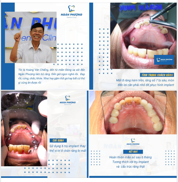 Ăn ngon nhai khoẻ, trẻ hoá nhờ implant