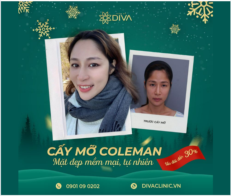 CẤY MỠ COLEMAN MẶT - GƯƠNG MẶT MỀM MẠI, TỰ NHIÊN