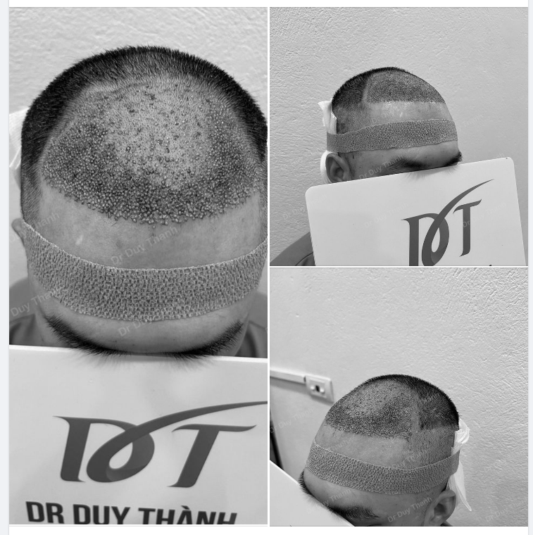 TRẢ KẾT QUẢ CẤY TÓC 1800 GRAFT BOY THANH HÓA