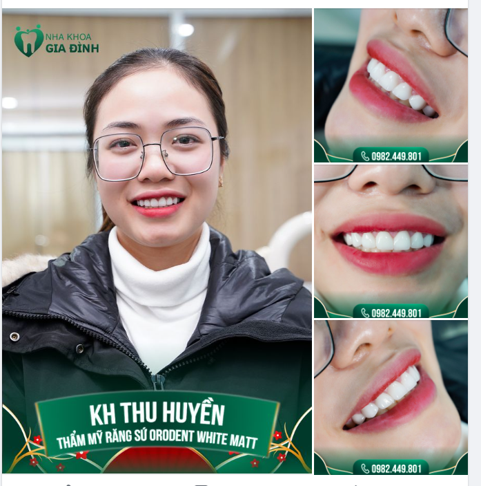 TỪ NGÀY CÓ HÀM RĂNG ĐẸP, MÌNH ĐÃ TỰ TIN CƯỜI HƠN