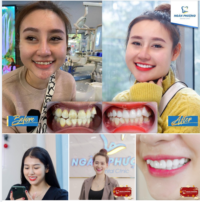 Thêm chút răng khểnh thôi mà sao xinh đẹp đến thế