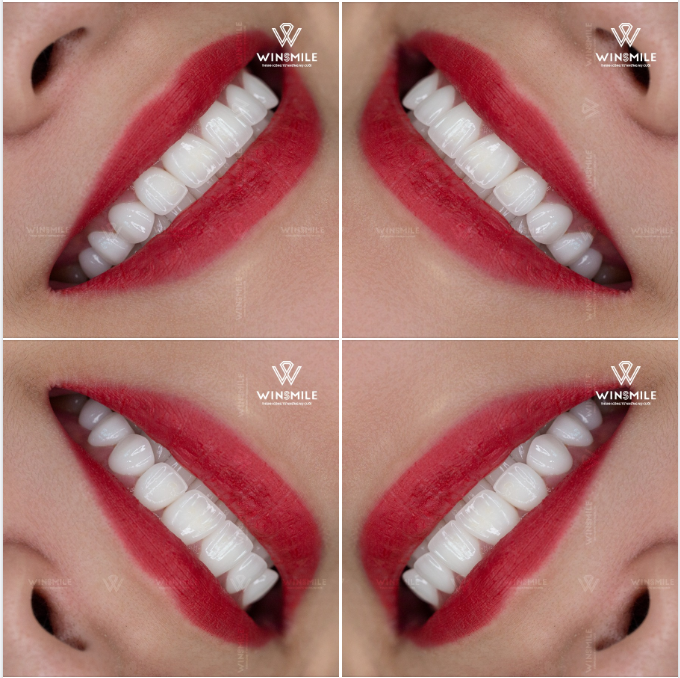 NỤ CƯỜI ĐẲNG CẤP MANG TÊN HT SMILE - VẺ ĐẸP HOÀN HẢO KHÔNG TÌ VẾT