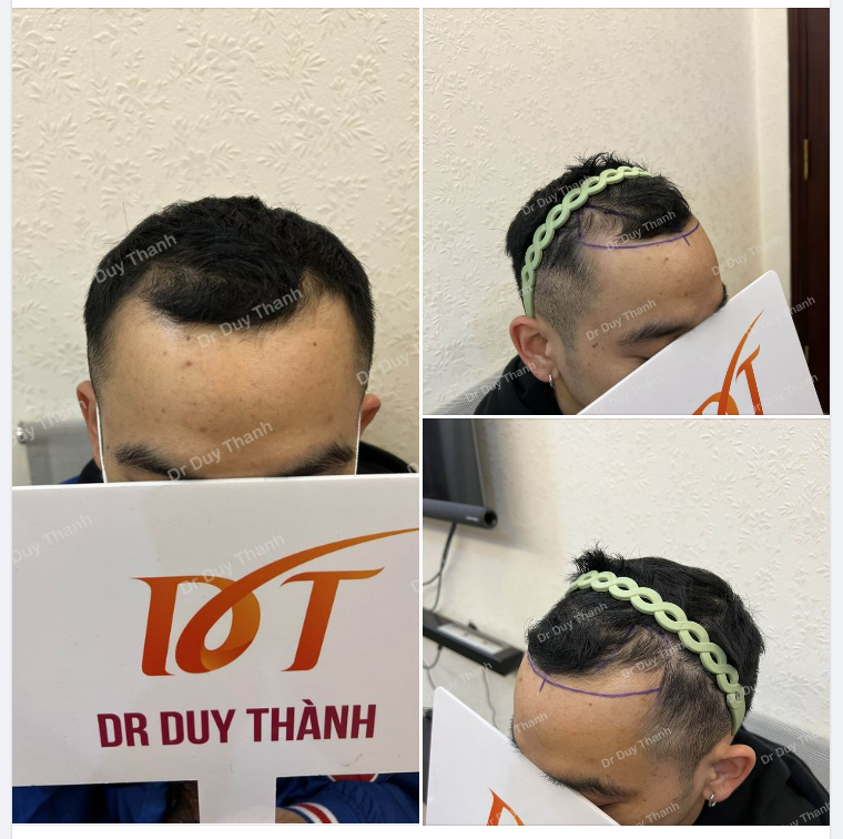 CHUẨN BỊ CẤY 1600 NANG BOY THÁI BÌNH 27 TUỔI