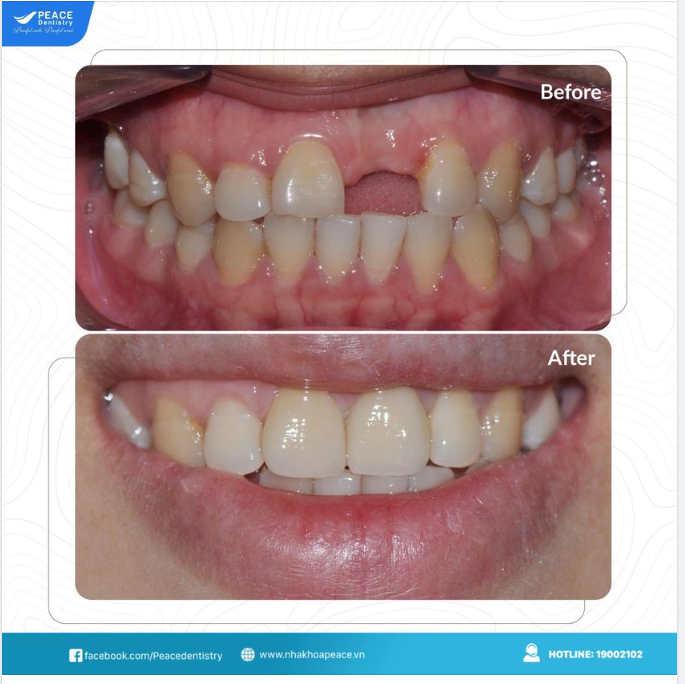 Mất răng cửa ảnh hưởng như thế nào đến sức khỏe răng miệng?