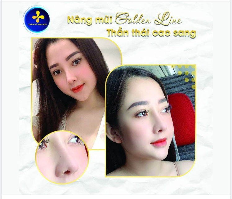 Thay đổi hoàn toàn chỉ với 1 dịch vụ. Cùng ngắm nhìn thành quả của khách hàng nâng mũi Golden Line tại Thẩm mỹ Như Hoa nhé.