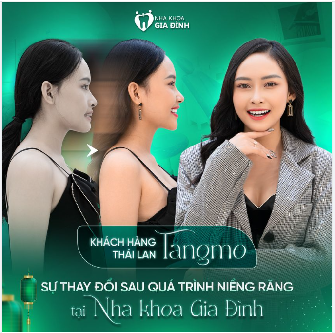 TRỞ THÀNH MẪU ẢNH SAU KHI NIỀNG RĂNG TẠI NHA KHOA GIA ĐÌNH