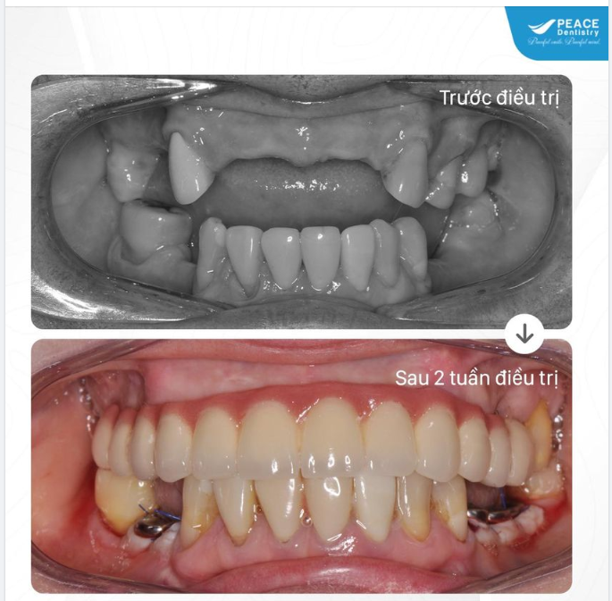 Ca lâm sàng All-on-6 Implant hàm trên thay thế hàm tháo lắp lâu năm và cấy 5 Implant thường quy ở hàm dưới cho khách hàng Việt Kiều.