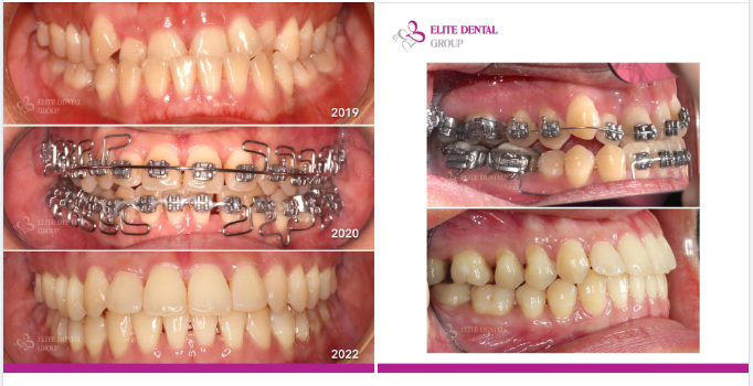 Không còn móm, khớp cắn khỏe, vui đón năm mới
