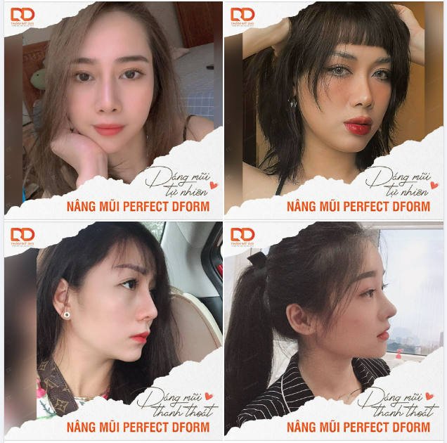 SỞ HỮU NÉT ĐẸP TỰ NHIÊN THANH THOÁT SAU NÂNG MŨI