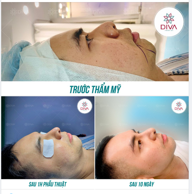 CẢI THIỆN SỐNG MŨI THẤP, CÁNH MŨI TO BÈ VỚI NÂNG MŨI TÁI CẤU TRÚC GHÉP SỤN TỰ THÂN