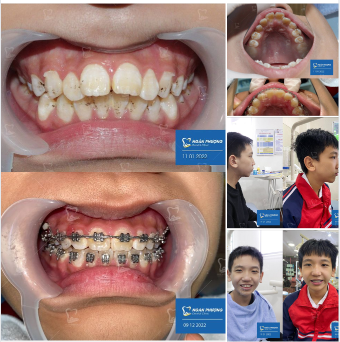 Niềng răng ở độ tuổi phù hợp luôn có được hiệu quả nhanh và thay đổi rõ rệt nhất.