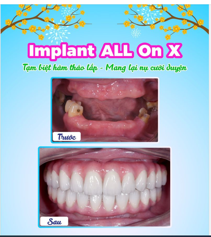 Implant ALL On X - Tạm biệt hàm tháo lắp - Mang lại nụ cười duyên