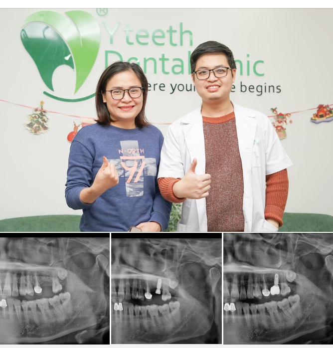 Nha khoa hẹn chị 6 tháng qua kiểm tra implant đình kì.