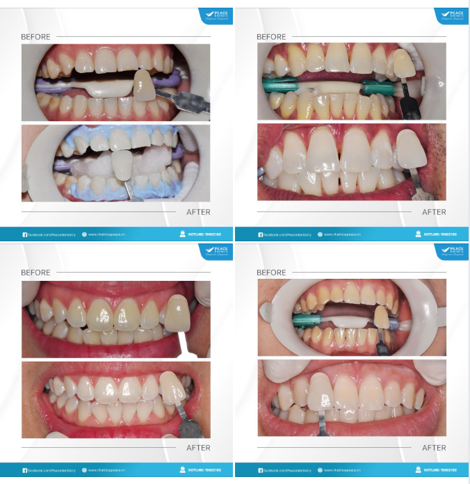 ĐÓN CHÀO NĂM MỚI 2023 - PEACE DENTISTRY TẶNG BẠN LÌ XÌ HẤP DẪN