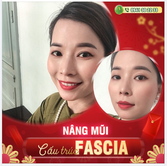 MŨI ĐẸP BỀN VỮNG NHỜ MÁY CHỤP CT 3D TẠI SAIGON VENUS