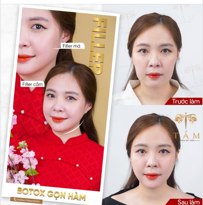 Chỉ sau 30 phút thực hiện, an toàn tuyệt đối với đội ngũ bác sỹ nhiều năm kinh nghiệm.