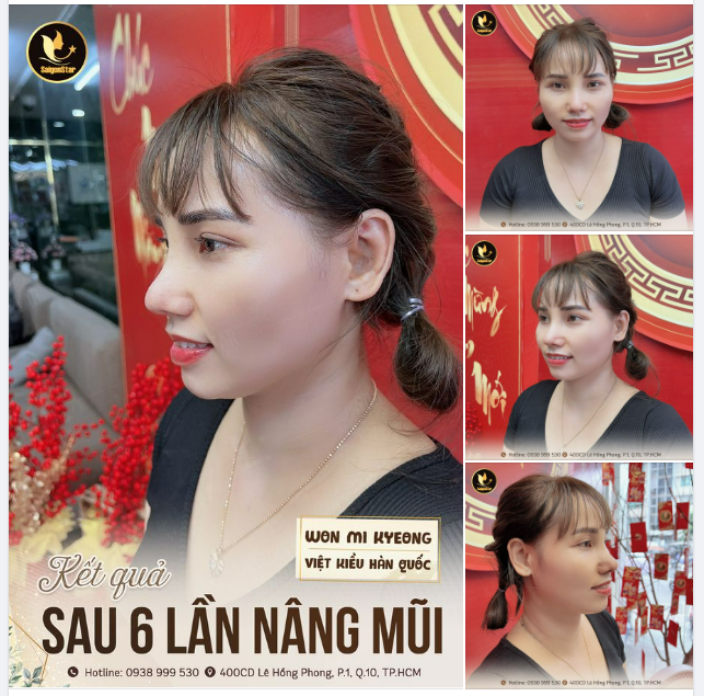 KẾT QUẢ SAU 6 LẦN NÂNG MŨI KH: WON MI KYEONG (VIỆT KIỀU HÀN QUỐC)
