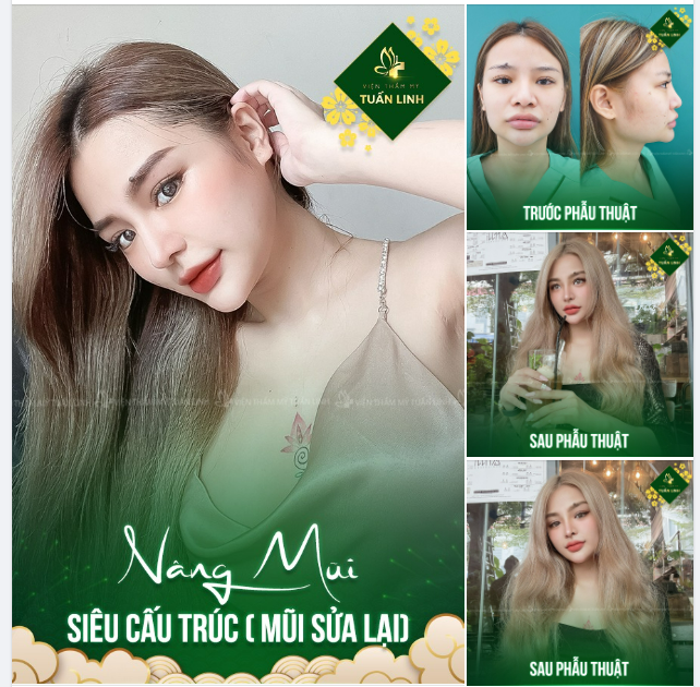 NÂNG MŨI SIÊU CẤU TRÚC ( MŨI SỬA LẠI) CHO CÔ NÀNG 9X XINH ĐẸP!!