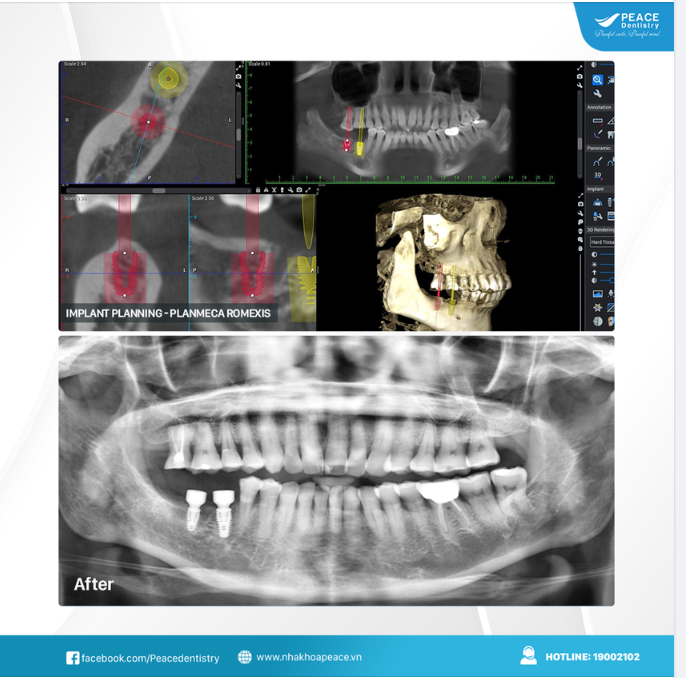 Ca lâm sàng cấy ghép 2 đơn vị Implant SIC (made in Germany)