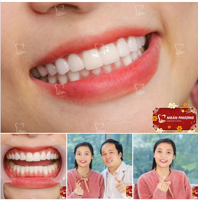 Răng sứ có cứ phải tone trắng nhất mới sáng đẹp?