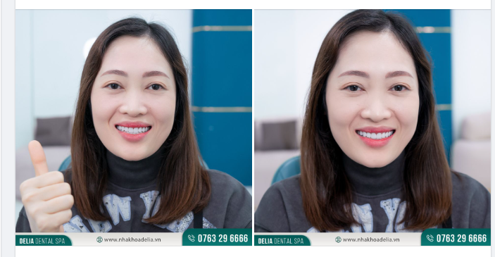 Quay trở lại Delia tái khám sau 6 tháng thẩm mỹ răng sứ, đội ngũ Delia tiếp đón chị rất chu đáo.