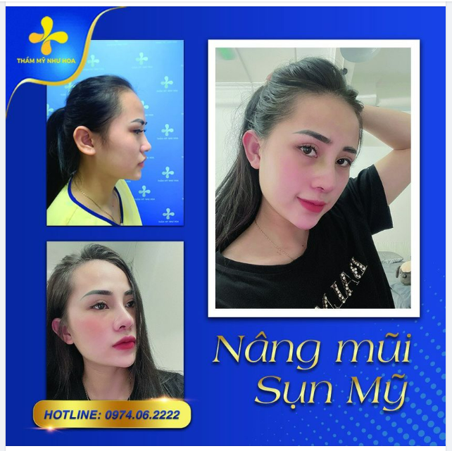 Cận cảnh góc nghiêng của khách hàng trước và sau khi nâng mũi sụn mỹ.