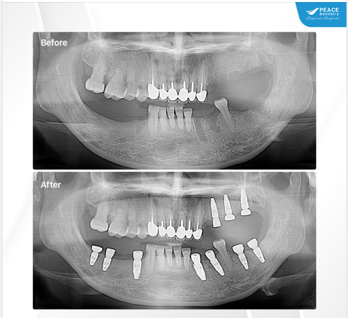 Ca lâm sàng implant với mục tiêu khôi phục hoàn chỉnh chức năng ăn nhai, nâng cao thẩm mỹ nụ cười để khách hàng có một cái Tết thật trọn vẹn và ý nghĩa!