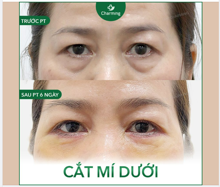 Sau nhiều bài viết về việc cắt mí dưới có thể giúp cải thiện phần bọng mắt thì Charming đã có một ví dụ minh hoạ cụ thể cho mọi người rồi đây
