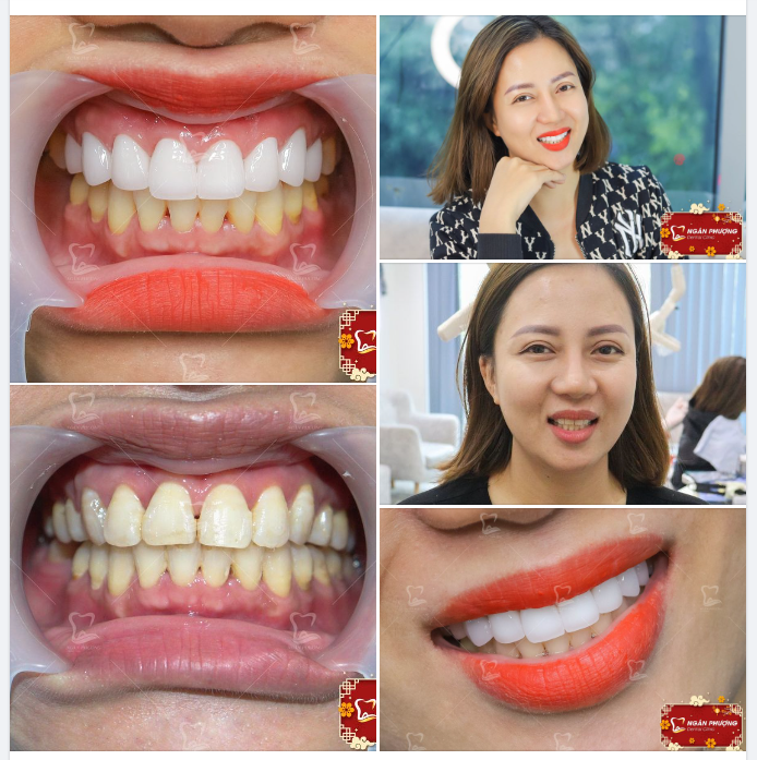 “Bác sĩ ơi, em làm sứ một hàm trước được không?”