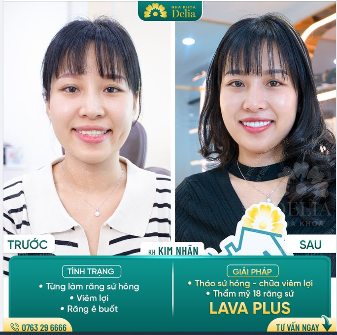 48H - GIẢI CỨU THÀNH CÔNG RĂNG SỨ HỎNG CHO VIỆT KIỀU HÀN QUỐC