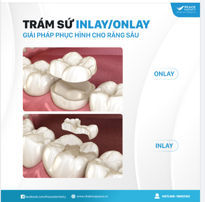 Trám sứ inlay onlay lựa chọn tối ưu dành cho răng sâu