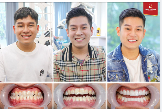 Răng khớp cắn ngược nhưng vẫn muốn bọc sứ khoẻ đẹp thì phải làm sao?